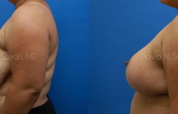 Breast Reduction Before and After | Sayah Institute