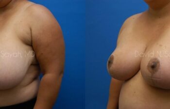 Breast Reduction Before and After | Sayah Institute