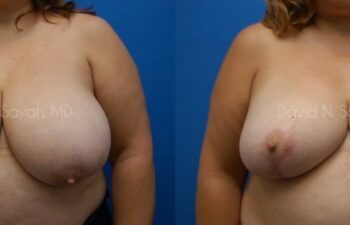 Breast Reduction Before and After | Sayah Institute