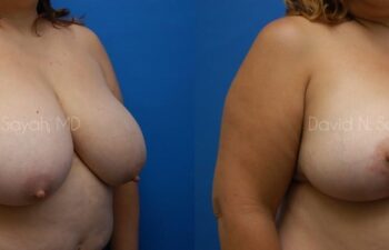 Breast Reduction Before and After | Sayah Institute