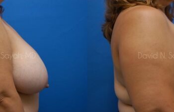 Breast Reduction Before and After | Sayah Institute