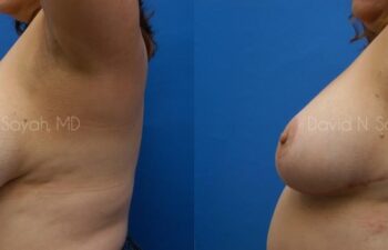 Breast Reduction Before and After | Sayah Institute