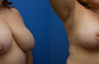 Breast Reduction Before and After | Sayah Institute