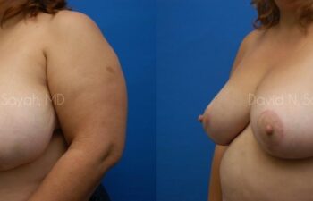 Breast Reduction Before and After | Sayah Institute