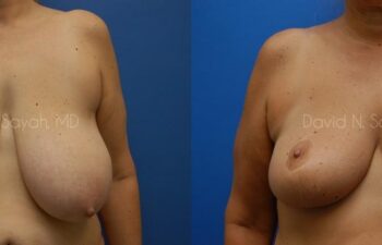 Breast Reduction Before and After | Sayah Institute