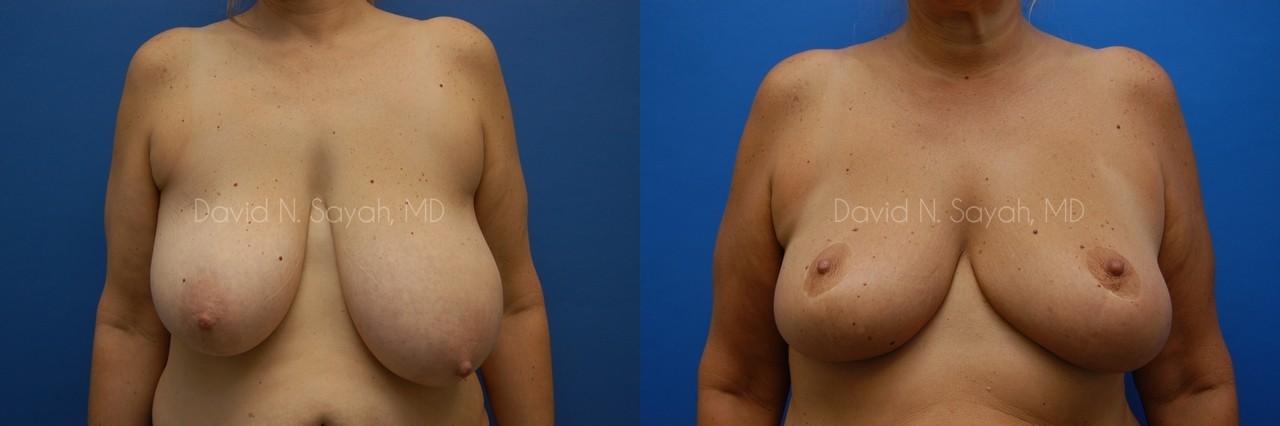 Breast Reduction Before and After | Sayah Institute