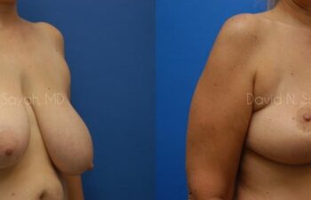 Breast Reduction Before and After | Sayah Institute