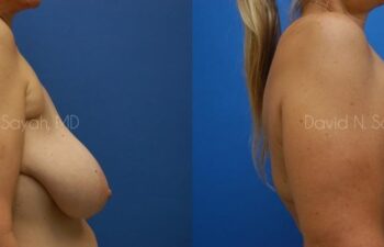 Breast Reduction Before and After | Sayah Institute