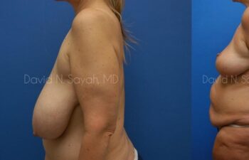 Breast Reduction Before and After | Sayah Institute