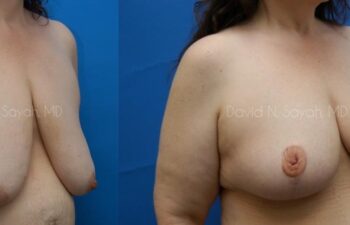 Breast Reduction Before and After | Sayah Institute