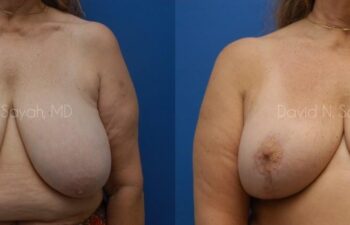 Breast Reduction Before and After | Sayah Institute