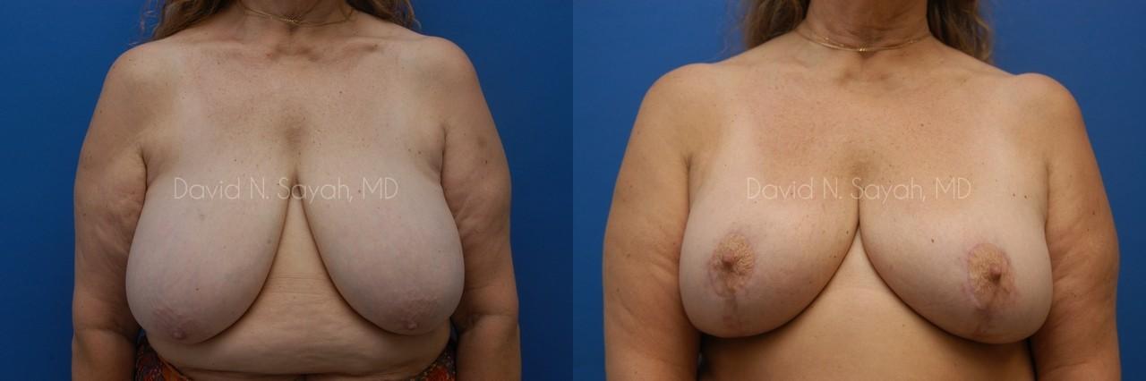Breast Reduction Before and After | Sayah Institute