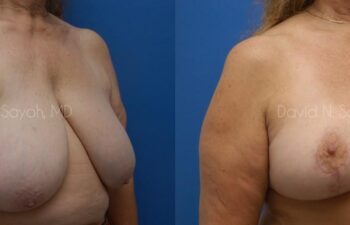 Breast Reduction Before and After | Sayah Institute