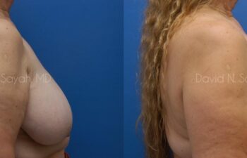 Breast Reduction Before and After | Sayah Institute