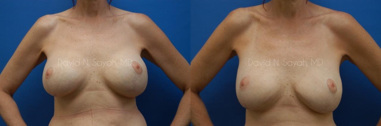 Breast Reconstruction Before and After | Sayah Institute