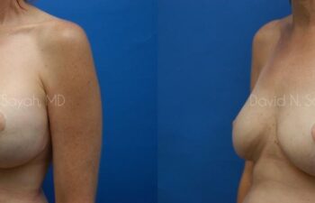Breast Reconstruction Before and After | Sayah Institute