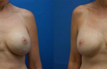 Breast Reconstruction Before and After | Sayah Institute