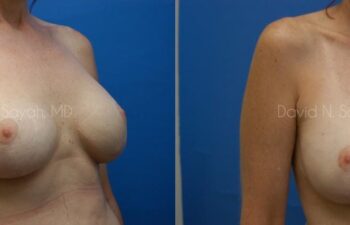 Breast Reconstruction Before and After | Sayah Institute