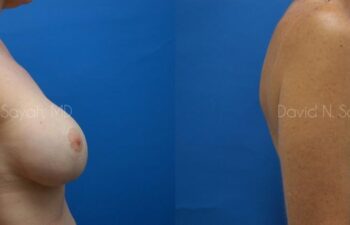 Breast Reconstruction Before and After | Sayah Institute