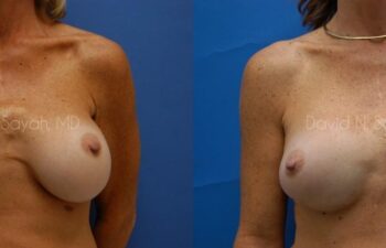 Breast Augmentation And Mastopexy Before and After | Sayah Institute