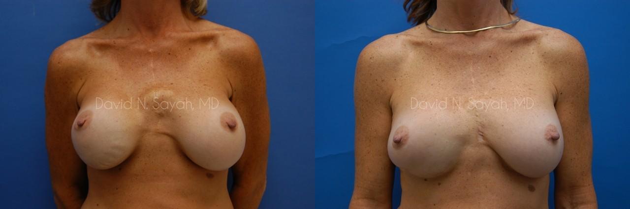 Breast Augmentation And Mastopexy Before and After | Sayah Institute