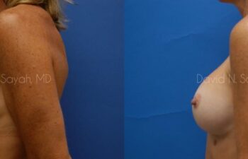 Breast Augmentation And Mastopexy Before and After | Sayah Institute
