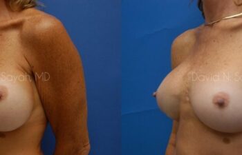 Breast Augmentation And Mastopexy Before and After | Sayah Institute