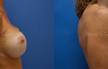 Breast Augmentation And Mastopexy Before and After | Sayah Institute