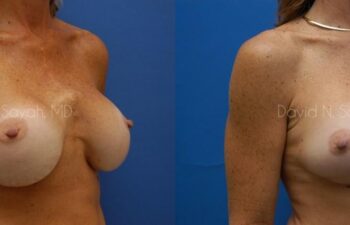 Breast Augmentation And Mastopexy Before and After | Sayah Institute