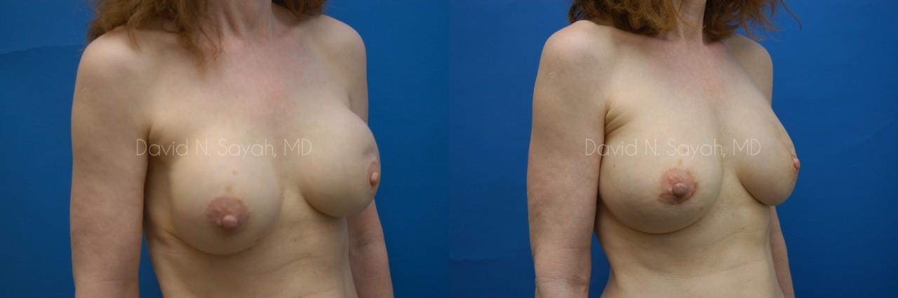 Breast Implant Exchange Before and After | Sayah Institute