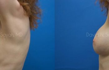Breast Implant Exchange Before and After | Sayah Institute