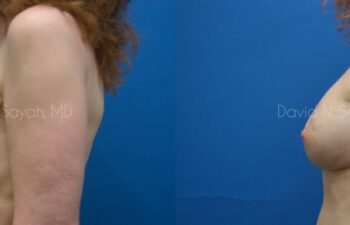 Breast Implant Exchange Before and After | Sayah Institute