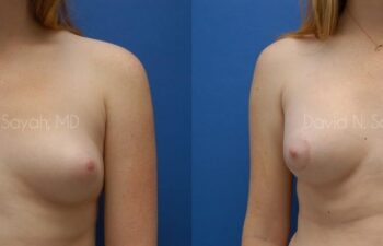 Breast Reconstruction Before and After | Sayah Institute