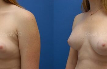 Breast Reconstruction Before and After | Sayah Institute