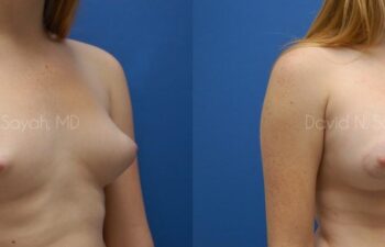 Breast Reconstruction Before and After | Sayah Institute