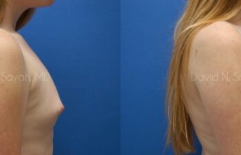 Breast Reconstruction Before and After | Sayah Institute