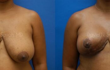 Breast Reconstruction Before and After | Sayah Institute