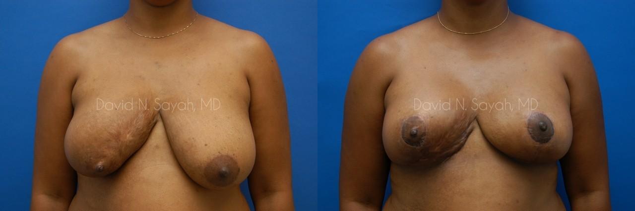 Breast Reconstruction Before and After | Sayah Institute