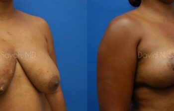Breast Reconstruction Before and After | Sayah Institute