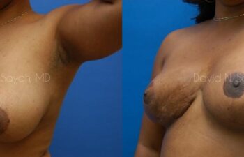 Breast Reconstruction Before and After | Sayah Institute