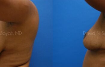 Breast Reconstruction Before and After | Sayah Institute
