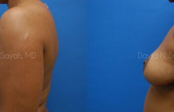 Breast Reconstruction Before and After | Sayah Institute