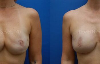 Breast Reconstruction Before and After | Sayah Institute