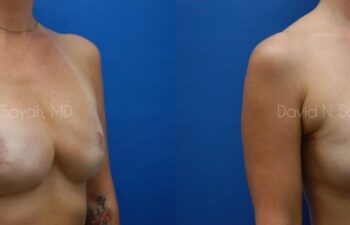Breast Reconstruction Before and After | Sayah Institute