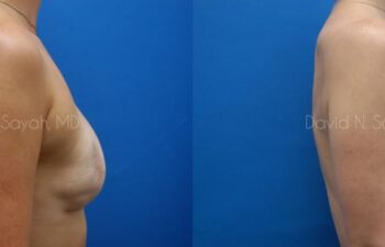 Breast Reconstruction Before and After | Sayah Institute