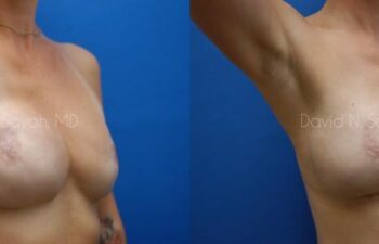 Breast Reconstruction Before and After | Sayah Institute
