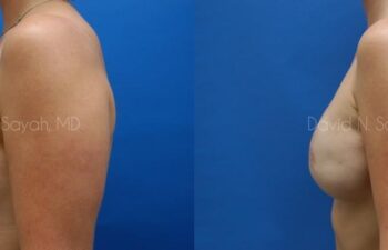 Breast Reconstruction Before and After | Sayah Institute