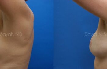 Breast Reconstruction Before and After | Sayah Institute