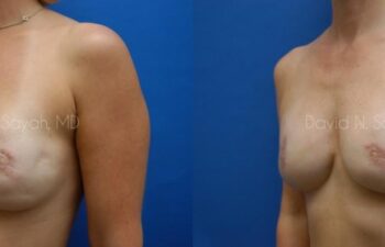 Breast Reconstruction Before and After | Sayah Institute