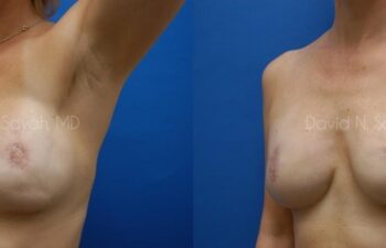Breast Reconstruction Before and After | Sayah Institute